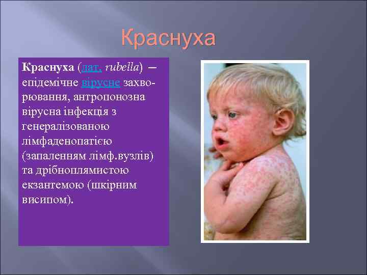 Краснуха (лат. rubella) — епідемічне вірусне захворювання, антропонозна вірусна інфекція з генералізованою лімфаденопатією (запаленням