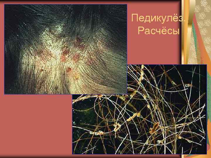 Педикулёз. Расчёсы 