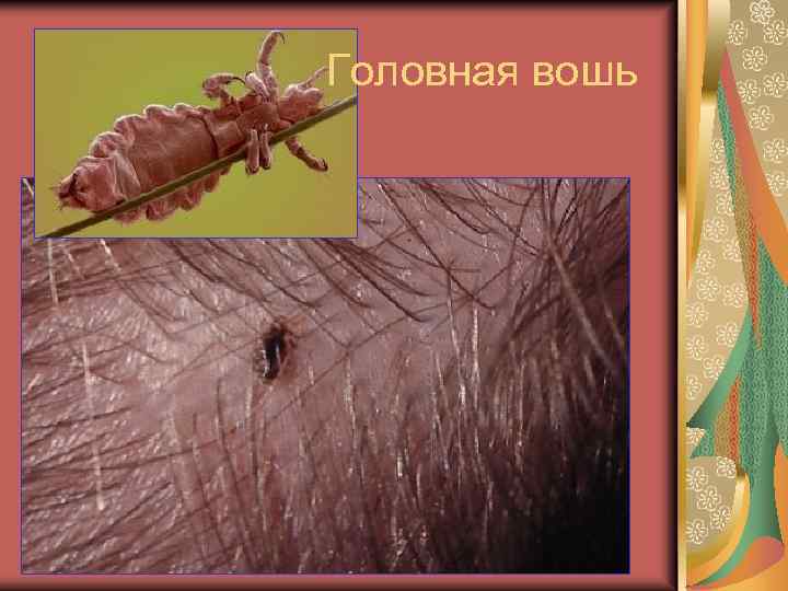 Головная вошь 