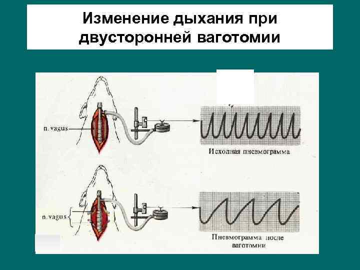 Изменение дыхания при двусторонней ваготомии 