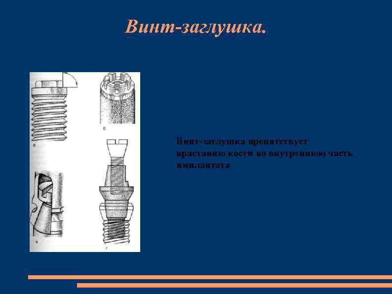 Винт-заглушка. Винт-заглушка препятствует врастанию кости во внутреннюю часть имплантата 