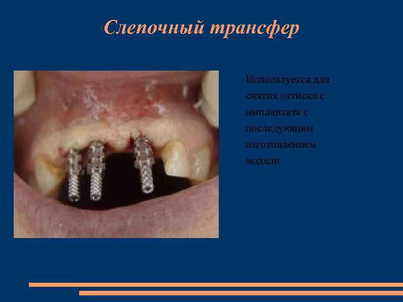 Слепочный трансфер Используется для снятия оттиска с имплантата с последующим изготовлением модели 