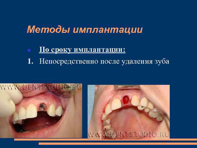 Методы имплантации По сроку имплантации: 1. Непосредственно после удаления зуба 