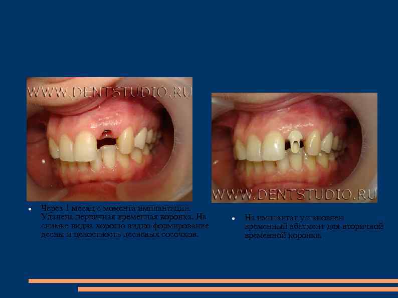  Через 1 месяц с момента имплантации. Удалена первичная временная коронка. На снимке видна