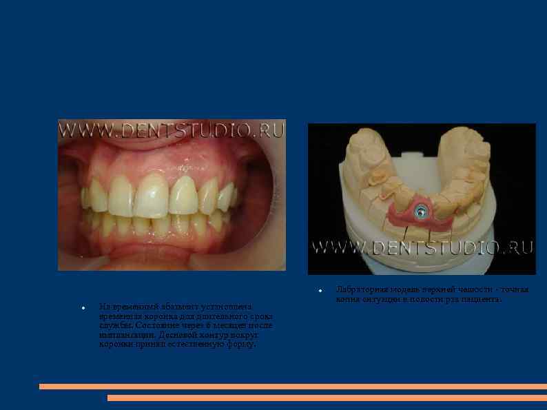  На временный абатмент установлена временная коронка для длительного срока службы. Состояние через 6