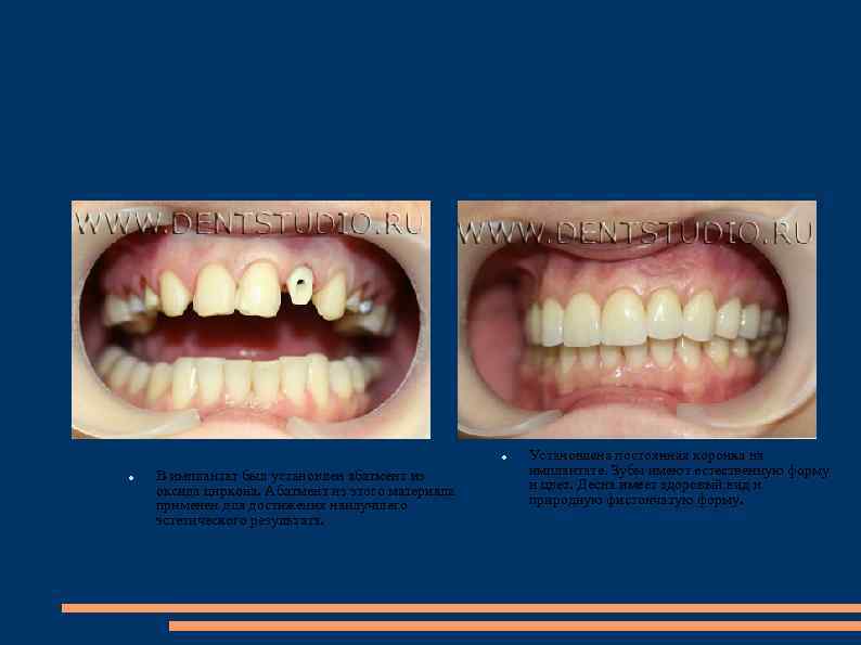  В имплантат был установлен абатмент из оксида циркона. Абатмент из этого материала применен