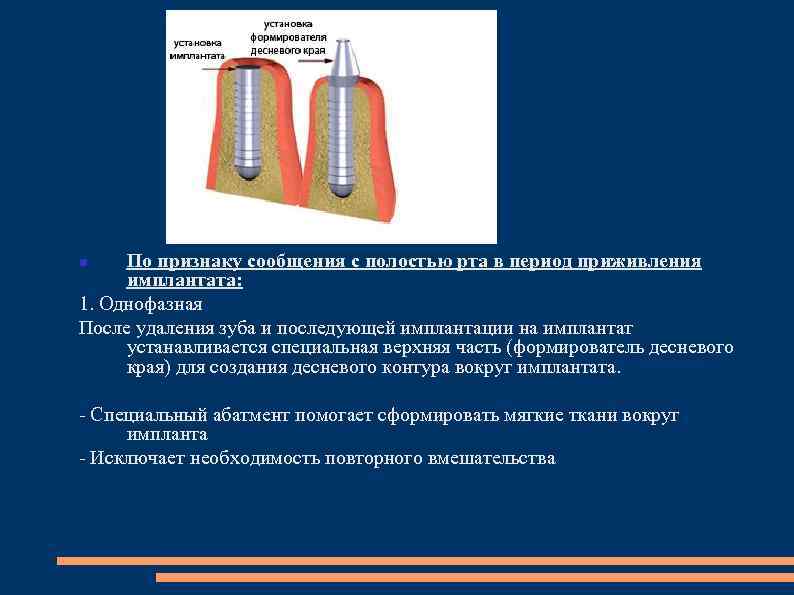 По признаку сообщения с полостью рта в период приживления имплантата: 1. Однофазная После удаления