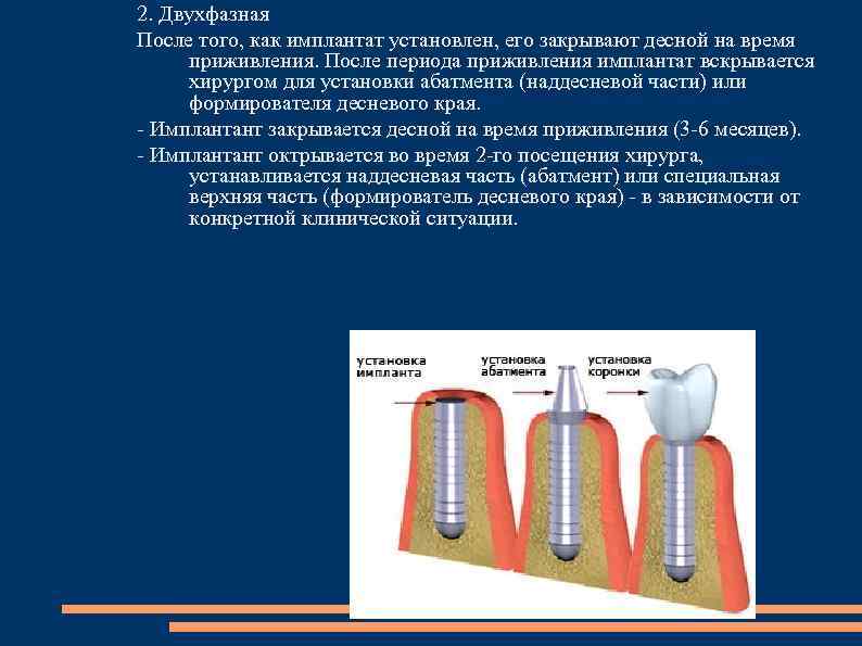 2. Двухфазная После того, как имплантат установлен, его закрывают десной на время приживления. После