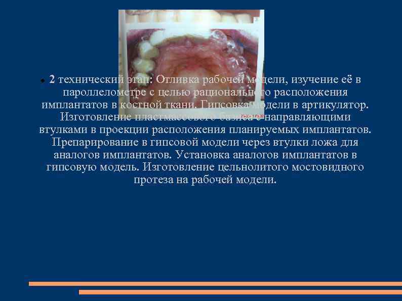 2 технический этап: Отливка рабочей модели, изучение её в пароллелометре с целью рационального расположения