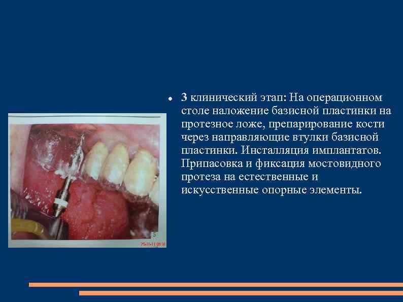  3 клинический этап: На операционном столе наложение базисной пластинки на протезное ложе, препарирование