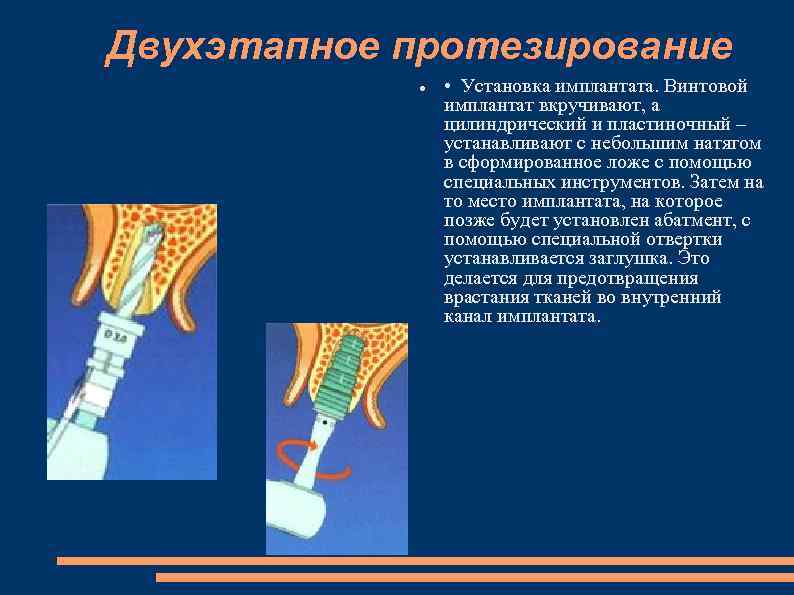 Двухэтапное протезирование • Установка имплантата. Винтовой имплантат вкручивают, а цилиндрический и пластиночный – устанавливают
