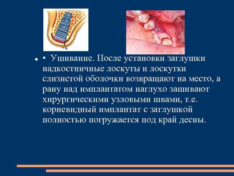  • Ушивание. После установки заглушки надкостничные лоскуты и лоскутки слизистой оболочки возвращают на