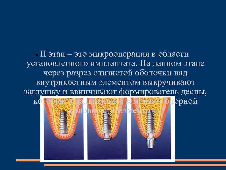 II этап – это микрооперация в области установленного имплантата. На данном этапе через разрез