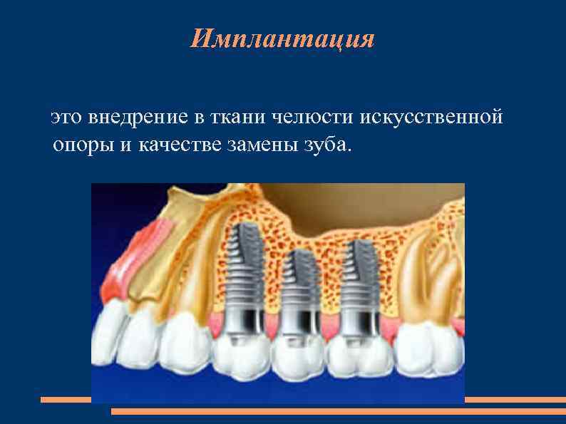 Имплантация это внедрение в ткани челюсти искусственной опоры и качестве замены зуба. 