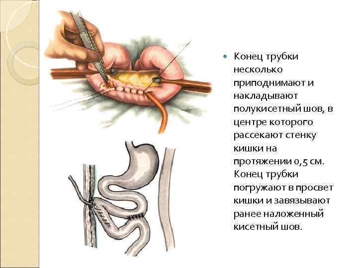  Конец трубки несколько приподнимают и накладывают полукисетный шов, в центре которого рассекают стенку
