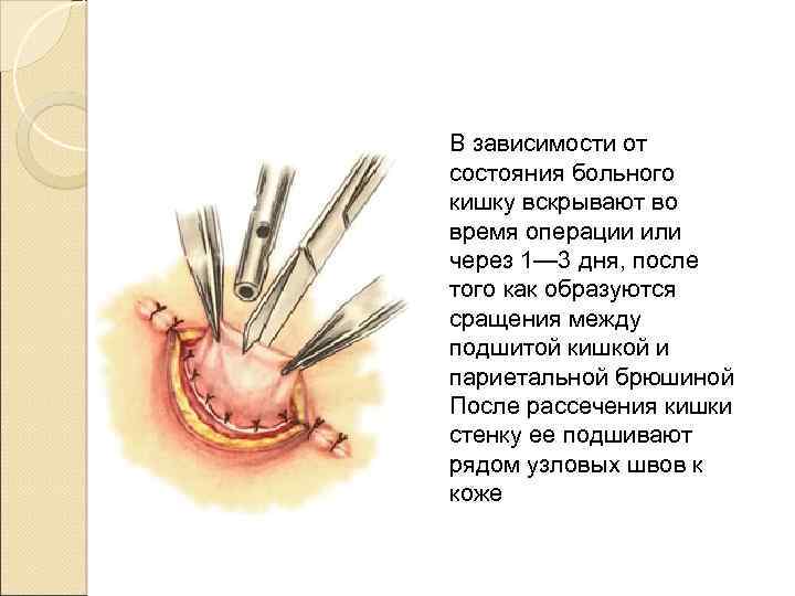 В зависимости от состояния больного кишку вскрывают во время операции или через 1— 3