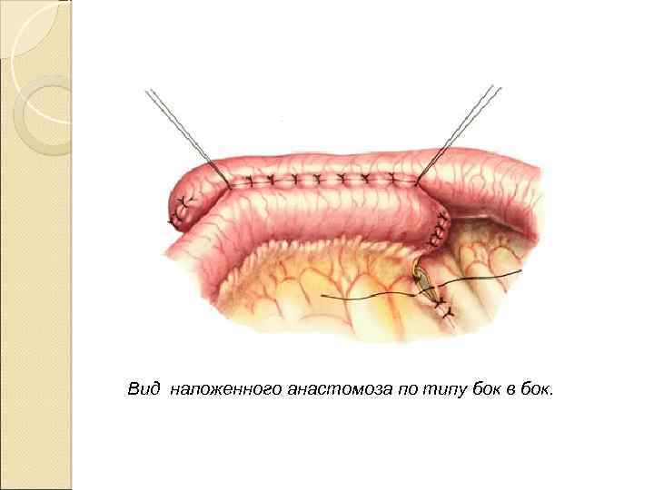 Вид наложенного анастомоза по типу бок в бок. 
