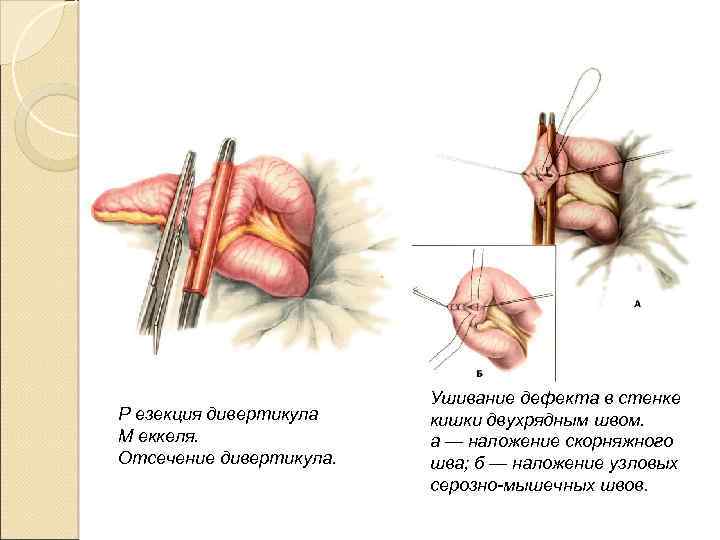 Р езекция дивертикула М еккеля. Отсечение дивертикула. Ушивание дефекта в стенке кишки двухрядным швом.