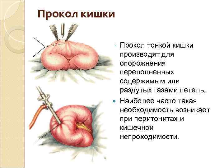 Прокол кишки Прокол тонкой кишки производят для опорожнения переполненных содержимым или раздутых газами петель.