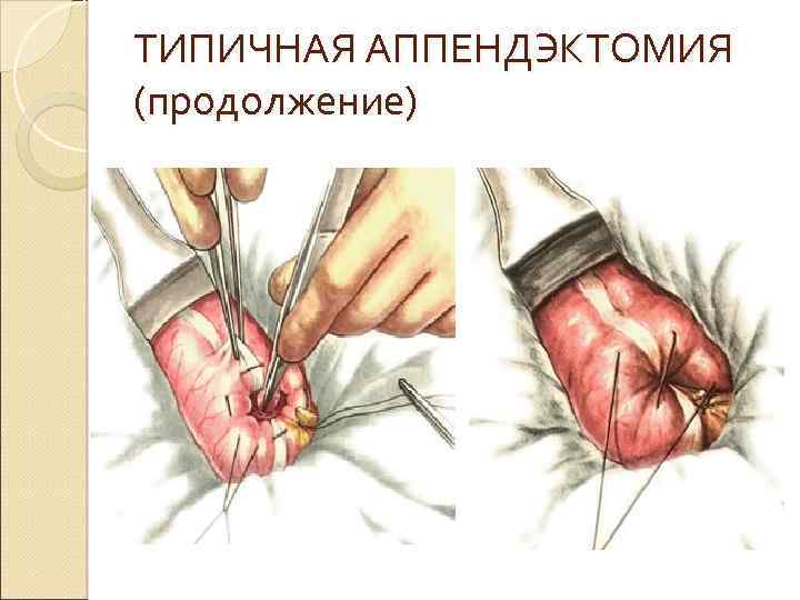 ТИПИЧНАЯ АППЕНДЭКТОМИЯ (продолжение) 