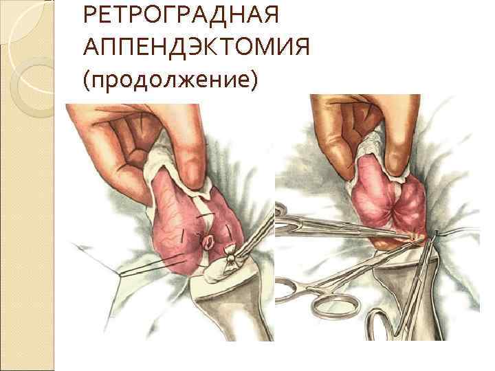 РЕТРОГРАДНАЯ АППЕНДЭКТОМИЯ (продолжение) 