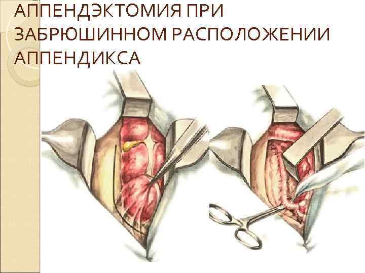 АППЕНДЭКТОМИЯ ПРИ ЗАБРЮШИННОМ РАСПОЛОЖЕНИИ АППЕНДИКСА 