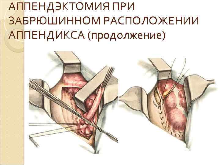 АППЕНДЭКТОМИЯ ПРИ ЗАБРЮШИННОМ РАСПОЛОЖЕНИИ АППЕНДИКСА (продолжение) 