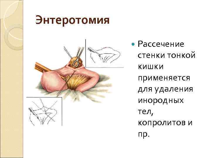 Энтеротомия Рассечение стенки тонкой кишки применяется для удаления инородных тел, копролитов и пр. 