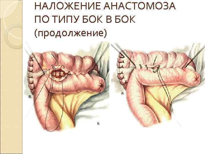 НАЛОЖЕНИЕ АНАСТОМОЗА ПО ТИПУ БОК В БОК (продолжение) 