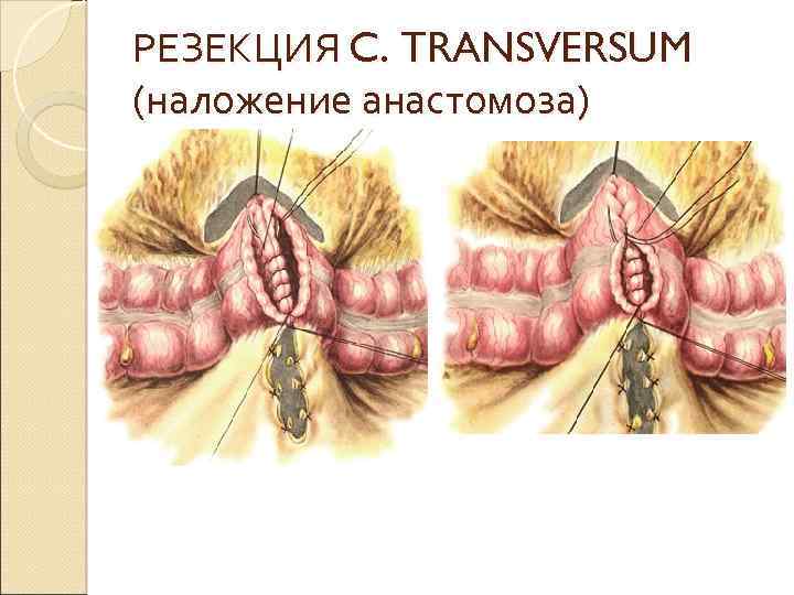 РЕЗЕКЦИЯ C. TRANSVERSUM (наложение анастомоза) 