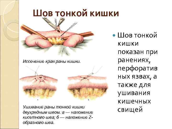 Шов тонкой кишки Иссечение края раны кишки. Ушивание раны тонкой кишки двухрядным швом. а