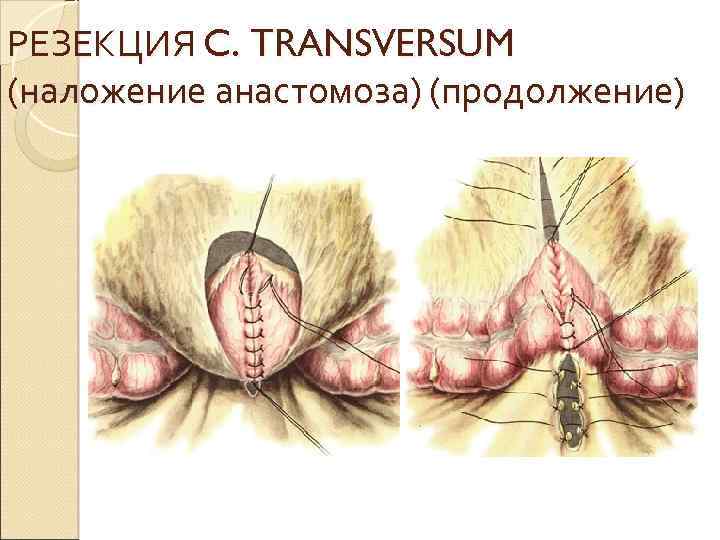 РЕЗЕКЦИЯ C. TRANSVERSUM (наложение анастомоза) (продолжение) 