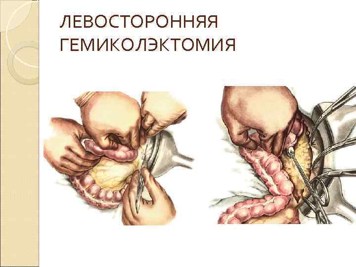 ЛЕВОСТОРОННЯЯ ГЕМИКОЛЭКТОМИЯ 