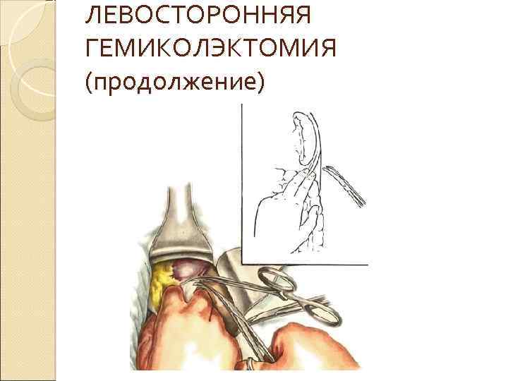 ЛЕВОСТОРОННЯЯ ГЕМИКОЛЭКТОМИЯ (продолжение) 