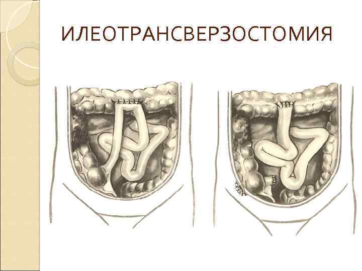 Операция лахея схема