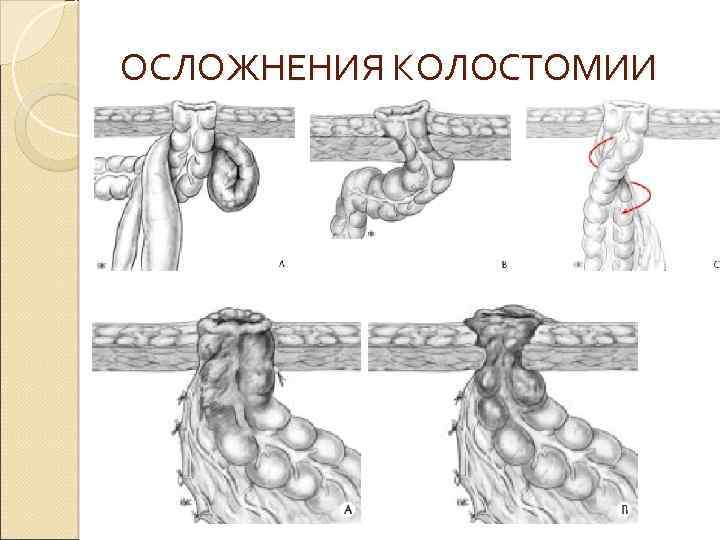 ОСЛОЖНЕНИЯ КОЛОСТОМИИ 