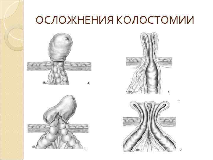 ОСЛОЖНЕНИЯ КОЛОСТОМИИ 