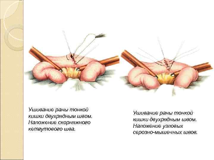 Ушивание раны тонкой кишки двухрядным швом. Наложение скорняжного кетгутового шва. Ушивание раны тонкой кишки