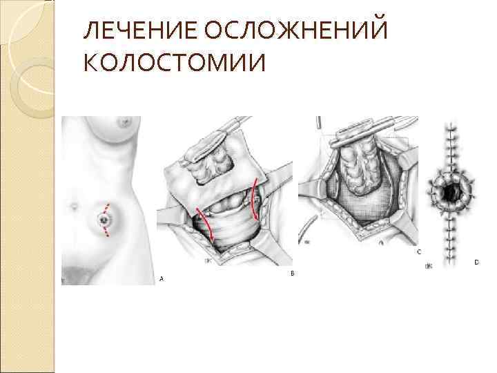 ЛЕЧЕНИЕ ОСЛОЖНЕНИЙ КОЛОСТОМИИ 