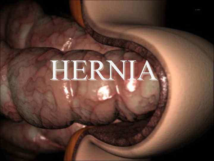 HERNIA 