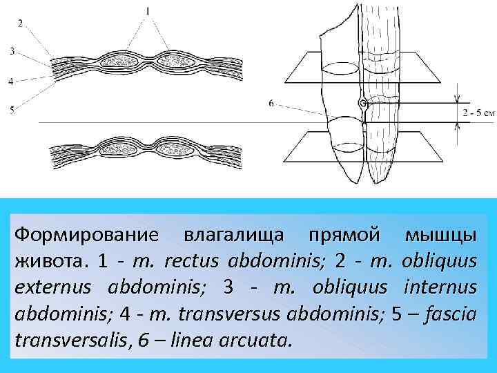 Формирование влагалища прямой мышцы живота. 1 - m. rectus abdominis; 2 - m. obliquus