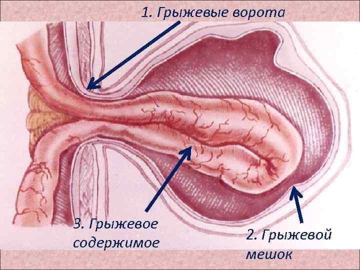 1. Грыжевые ворота 3. Грыжевое содержимое 2. Грыжевой мешок 