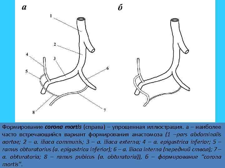 Формирование corona mortis (справа) – упрощенная иллюстрация. а – наиболее часто встречающийся вариант формирования