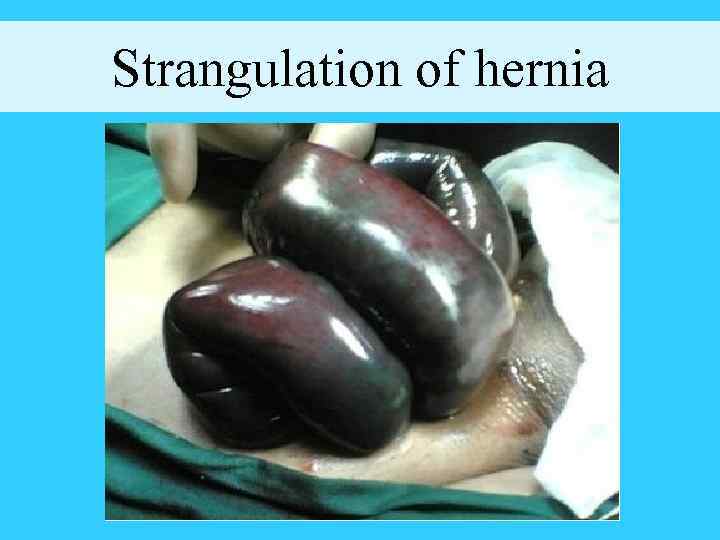 Strangulation of hernia 