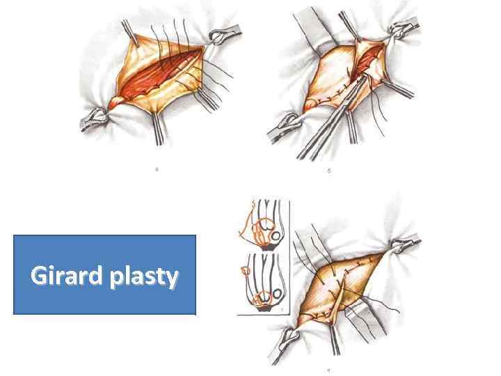 Girard plasty 