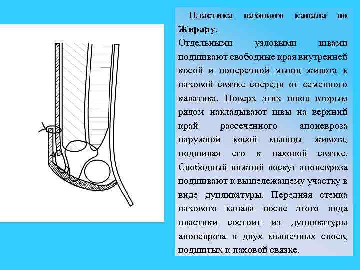 Схемы пластики пахового канала