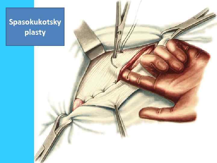 Spasokukotsky plasty 