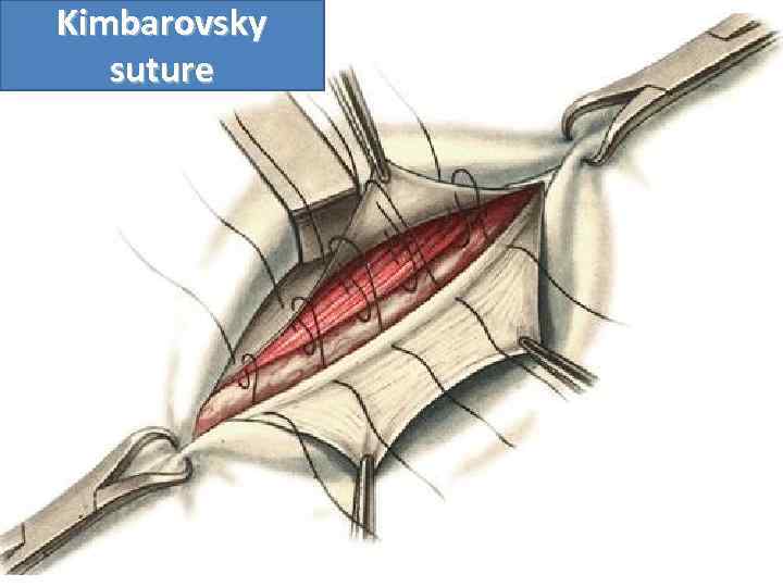 Kimbarovsky suture 