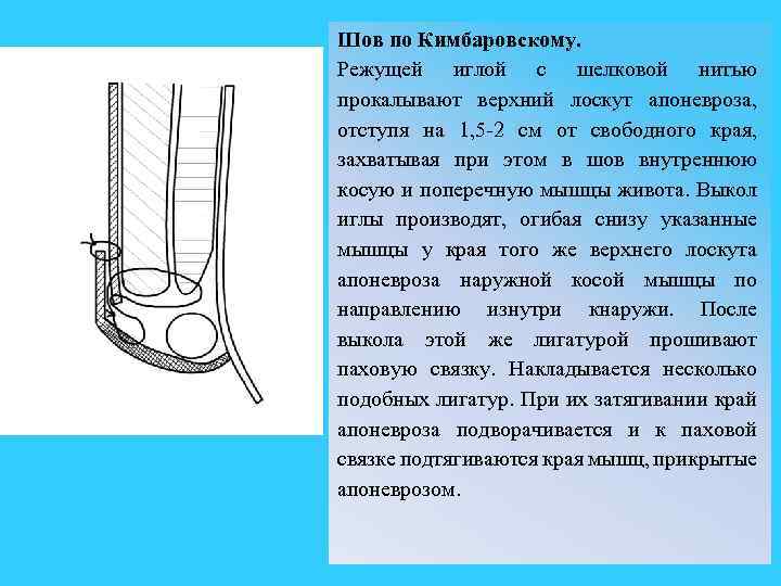 Пластика пахового канала по кимбаровскому