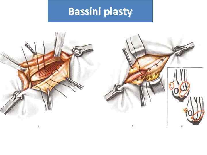 Bassini plasty 